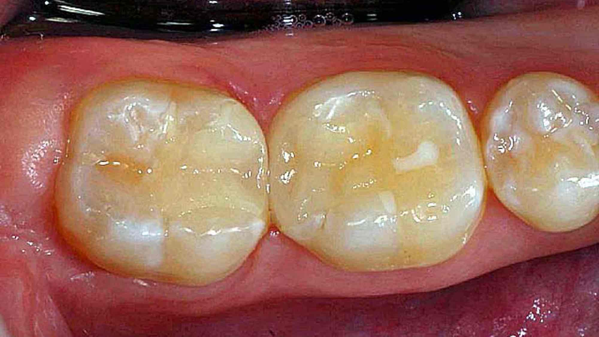 ceramic inlays