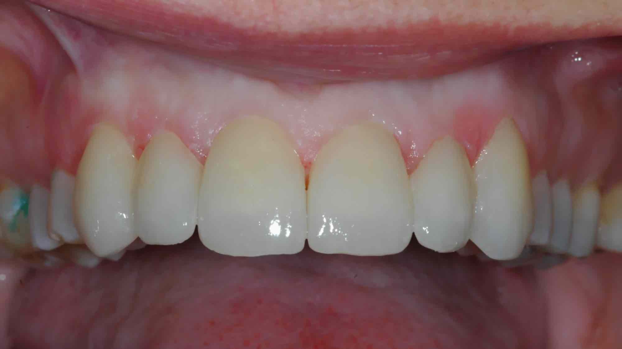 Veneers upper front